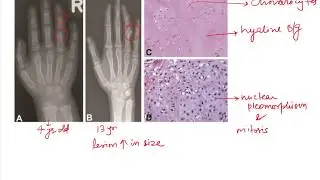 Ollier Disease and Maffucci Syndrome