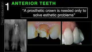 Post Endodontic Restoration from root canal preparation to occlusal check. Overview by Dr. G.Cavalli