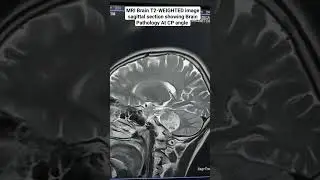 MRI Brain T2 Sequence Sagittal To rule out Pathology #beginners #radiology #mri  #siemens