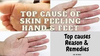 Palm skin peeling in hindi | palm peeling in Summer | Skin peeling treatment at home