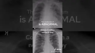 CXR : What is the diagnosis ?