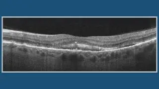 1 Retinal Pigment Epithelium (RPE)