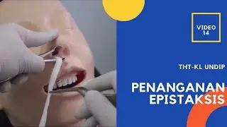 Penanganan Epistaksis