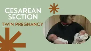 Cesarean Section on Twin Pregnancy