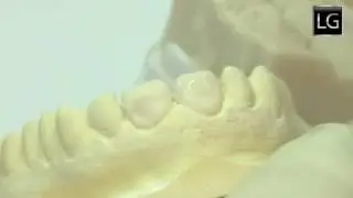 Live wax up of anterior teeth from start to finish