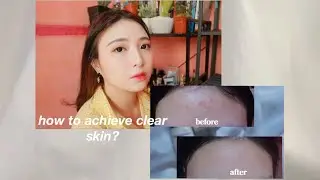 How I got rid of my breakouts + foundation routine (Klair's Angry Skin Calming Package) 🍑