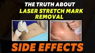 The Truth about Laser Stretch Mark Removal || Side Effects || Dr. Keerthana Kalva || Inform Clinic