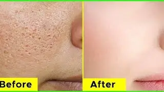 How to get rid of Large Open Pores Permanently | JSuper kaur