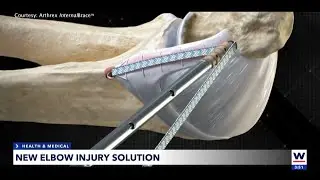Teen pitchers find new hope with UCL repair alternative