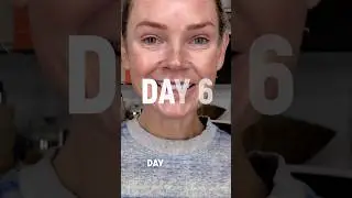 DAY 6 TCA Peel Skin Shed #skinpeel