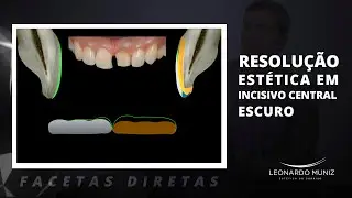 Facetas Diretas: Resolu&ccedil;&atilde;o Est&eacute;tica em Incisivo Central Escuro | Leonardo Muniz
