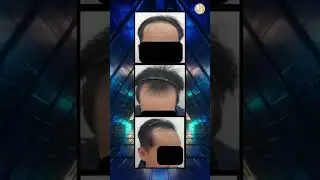 M-shape Hairline Transplant  #baldnesssolution #fuehairtransplant #smartfue #fue #hairloss #hair