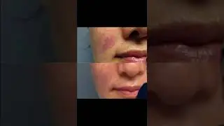 Laser Treatment of Birthmark