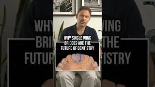 Why Single Wing Bridges Are the Future of Dentistry!