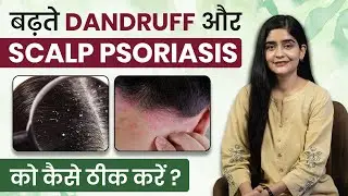 बढ़ते Dandruff और Scalp Psoriasis को कैसे ठीक करें ? | Tips to Prevent Dandruff in Winters