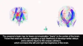Infant brain imaging