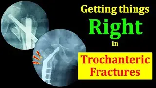 Getting Things Right in Trochanteric Fractures