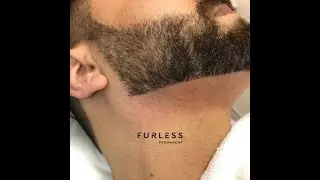 Electrolysis for Men in UAE & KSA | Say Goodbye to Unwanted Hair Forever with Furless Permanent