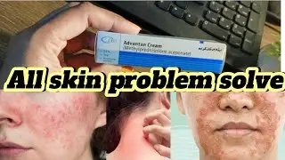Advantan cream honest review's best for skin egzima alergy redness and pimple 