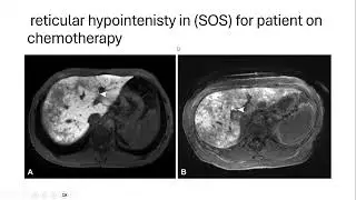Hypointense Findings on Hepatobiliary Phase MR Images. Dr. Salma EL galad