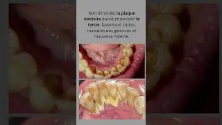 La Plaque Dentaire vs. le Tartre