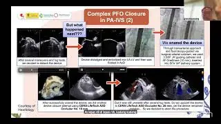 PFLO closure in PA IVS for nurse