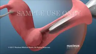 Pap Testi (Smear Testi) - Op.Dr.Neslihan Hazar