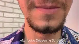 Voice Deepening/Masculinization Surgery