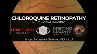 CHLOROQUINE RETINOPATHY - MULTIMODAL RETINAL IMAGING ANALYSIS