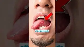 Aft neden olur?