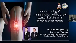 Meniscal allograft transplantation will be a gold standard or dilemma: Evidence based update