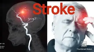 Stroke, ischemic vs hemorrhagic. negative effect of aspirin on hemorrhahic stroke