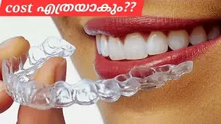 Clear Aligners Rate??? cost / pallil kambi idunnath malayalam / braces / aligners/ palludr / viral