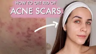 How to get rid of ACNE SCARS AND HYPERPIGMENTATION | clear skin