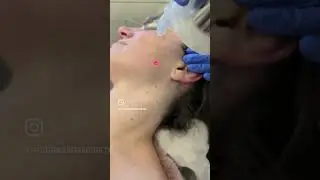 Micro Laser Peel 