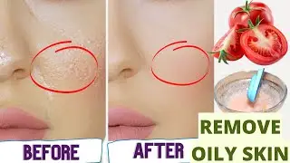How to Get rid of Oily Skin Permanently - Home Remedies for Oily Skin & Pimples - Get Glowing Skin