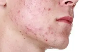 Common Acne Mistakes - Not Paying Attention to Scars