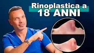 RINOPLASTICA A 18 ANNI: Come Funziona? Cosa Aspettarsi? (vlog 05)