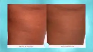 NeriumFirm smz