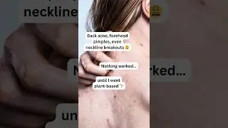 Back Acne & Forehead Pimples | Clear Skin Tips That Actually Work #acnefree