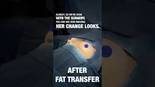 Can you combine petite breast augmentation and fat grafting with Max Tuck&reg;️🥇? #beforeandafter