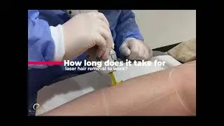 Laser hair removal in Dubai by Candela Gentle max pro