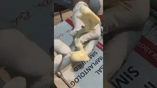 Nerve bypass technique. Engaging Compressive implant in the mylohyoid bone