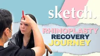Rhinoplasty Recovery Journey | First Look After Surgery at SKETCH Plastic Surgery 🇰🇷✨