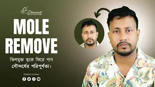 🔥 মোল লেজার ট্রিটমেন্ট &ndash; তিল দূর করার নিরাপদ উপায় ! Mole Laser Treatment