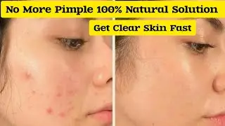 How To Remove Pimples Overnight | Acne Treatment At Home | Remove Acne Marks.