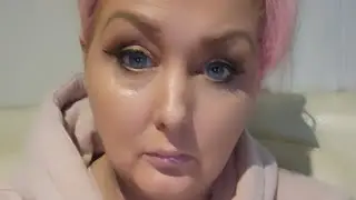 My negative ETS surgery experience | Catherine's story | ETS Surgery for blushing and hyperhidrosis