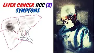LIVER CANCER (HCC); Symptoms (2)