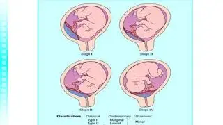 محاضرة تمريض الصحة الانجابيةbleeding in late of pregnancyد/ سماح عبدالحليم فرقة ثالثة  18/11/2020