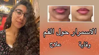 الاسمرار حول الفم .. السبب و الوقاية و العلاج